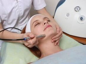 A facial laser rejuvenation