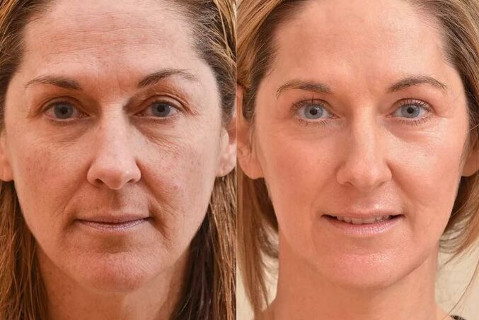 Face -to -face rejuvenation before and after