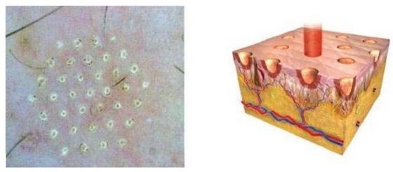 Breakdown lasers affect skin points