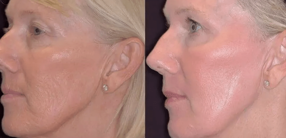 Laser photothermolysis before and after