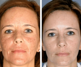 The effect of the procedure
