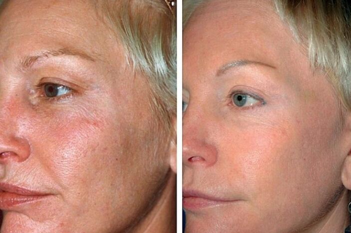 Before and after rejuvenating procedures