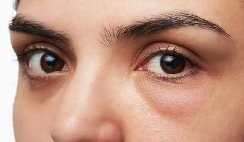 Bag under the eyes, swollen