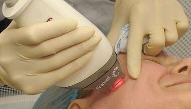 How is fractional skin rejuvenation done