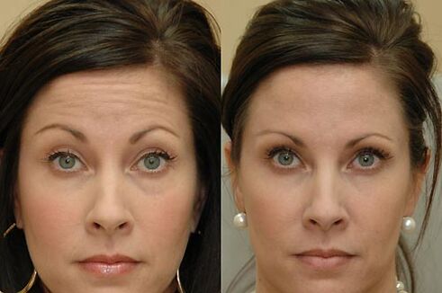Botulinum toxin injections are suitable for use in any area of ​​the face
