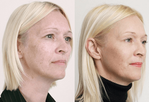 Simple peeling with fruit acid