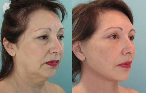 Thread lifting results