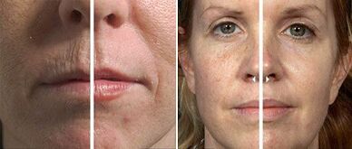 before and after fractional skin rejuvenation
