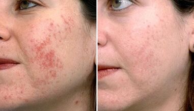 pictures before and after fractional skin rejuvenation