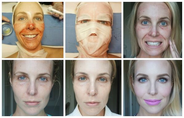 Facial skin healing stage after successful plasma lifting