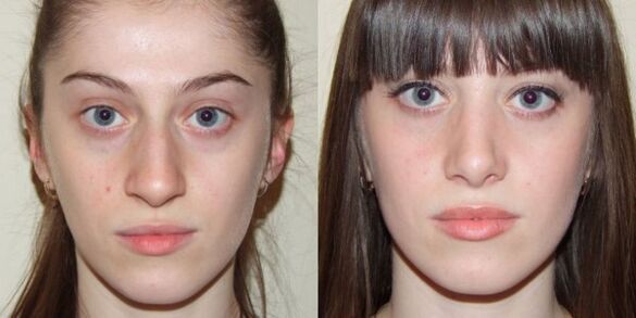 Girls before and after plasma facial skin rejuvenation