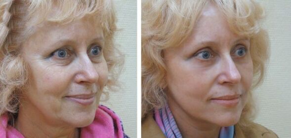Women before and after plasma facial skin rejuvenation